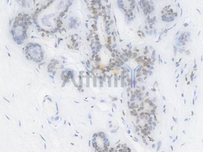EHMT2 Recombinant Rabbit mAb - BF4422 at 1/100 staining Human breast carcinoma by IHC-P.