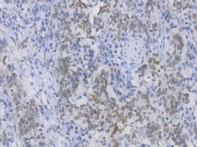 EHMT2 Recombinant Rabbit mAb - BF4422 at 1/100 staining Human gastric carcinoma by IHC-P.
