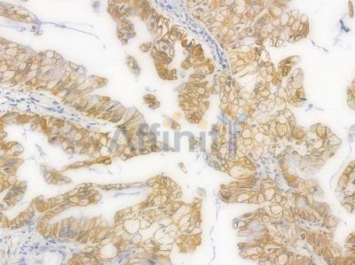 Cytochrome P450 1A2 Recombinant Rabbit mAb - BF4437 at 1/100 staining Human pancreatic carcinoma by IHC-P.