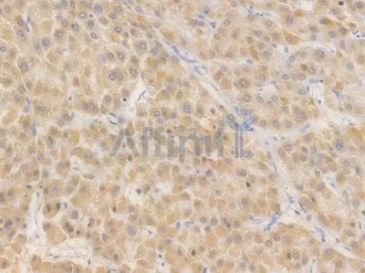 CPS1 Recombinant Rabbit mAb - BF4467 at 1/100 staining Human liver carcinoma by IHC-P.