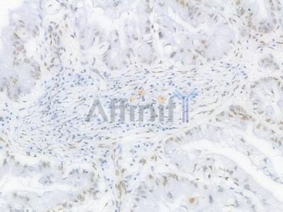 PRMT1 Recombinant Rabbit mAb - BF4473 at 1/100 staining Human pancreatic carcinoma by IHC-P.