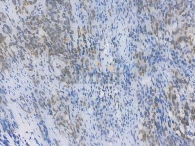 PRMT1 Recombinant Rabbit mAb - BF4473 at 1/100 staining Human gastric carcinoma by IHC-P.