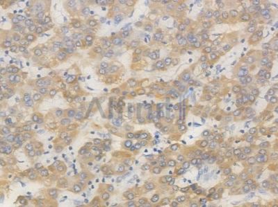 ACAT1 Recombinant Rabbit mAb - BF4484 at 1/100 staining Human liver carcinoma by IHC-P.