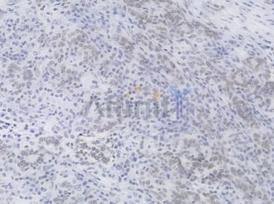 Phospho-POLR2A (Ser2) Recombinant Rabbit mAb - BF4510 at 1/100 staining Human gastric carcinoma by IHC-P.