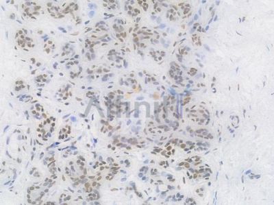 Phospho-POLR2A (Ser2) Recombinant Rabbit mAb - BF4510 at 1/100 staining Human breast carcinoma by IHC-P.