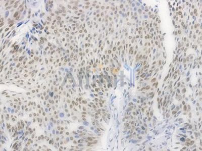 Phospho-POLR2A (Ser2) Recombinant Rabbit mAb - BF4510 at 1/100 staining Human renal carcinoma by IHC-P.