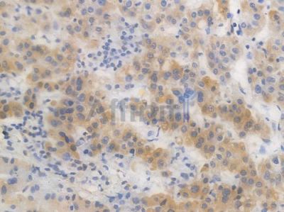 PI3 Kinase Class III Recombinant Rabbit mAb - BF4520 at 1/100 staining Human liver carcinoma by IHC-P.