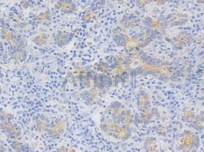 PI3 Kinase Class III Recombinant Rabbit mAb - BF4520 at 1/100 staining Human gastric carcinoma by IHC-P.