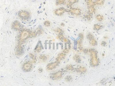 ABCD3 Recombinant Rabbit mAb - BF4551 at 1/100 staining Human breast carcinoma by IHC-P.