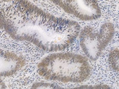RAD50 Recombinant Rabbit mAb - BF4568 at 1/100 staining Human intestinal carcinoma by IHC-P.