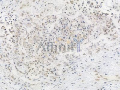 RAD50 Recombinant Rabbit mAb - BF4568 at 1/100 staining Human esophageal carcinoma by IHC-P.
