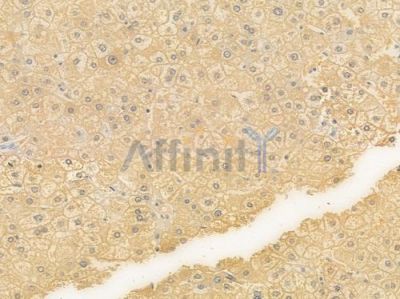 CTH Recombinant Rabbit mAb - BF4594 at 1/100 staining Human liver carcinoma by IHC-P.