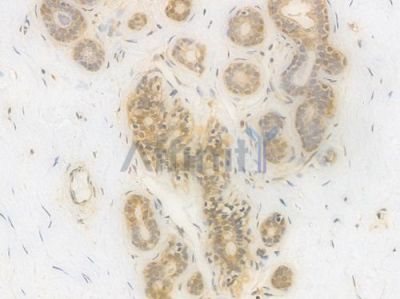 GSTP1 Recombinant Rabbit mAb - BF4607 at 1/100 staining Human breast carcinoma by IHC-P.