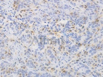 CD244 Recombinant Rabbit mAb - BF4624 at 1/100 staining Human gastric carcinoma by IHC-P.