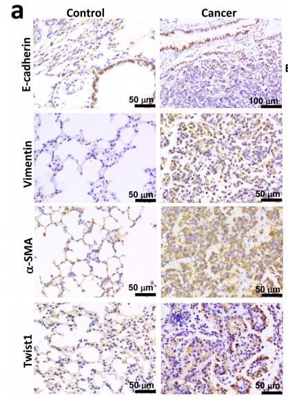 Twist1 Antibody - (a) Representative immunohistochemical staining of E-cadherin, vimentin, α-SMA and twist1 in AFG1-induced lung adenocarcinoma.