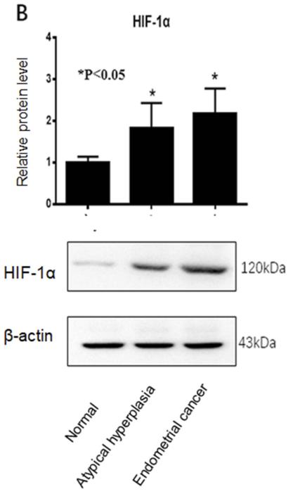 HIF1A Antibody - Figure 2| Western blot analysis of PHD2 and HIF-1α protein expression in normal endometrium, atypical endometrial hyperplasia, and endometrial cancer.