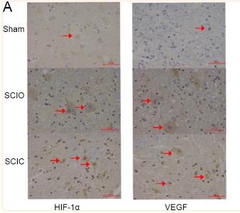 HIF1A Antibody - Figure 5
Influence of spinal canal environment on changes in immunohistochemical staining after primary spinal cord injury in different groups at 7 days post-operation.