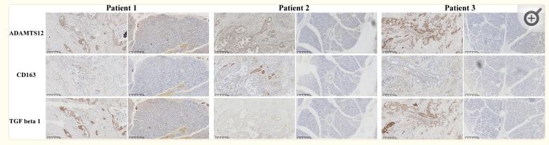 TGF beta 1 Antibody - Figure 9
The immunohistochemistry results of ADAMTS12, CD163, and TGF-beta 1 in 3 patients.