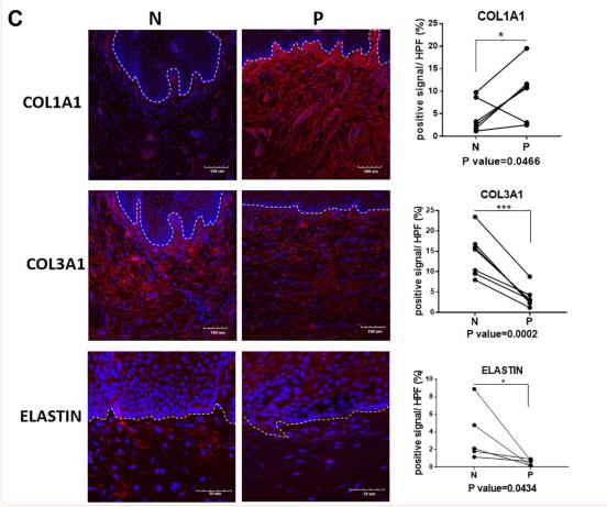 Collagen I Antibody - Figure 2
Quantification analyses of type I collagen, type III collagen and elastin in vagina tissue of pelvic organ prolapsed patients.