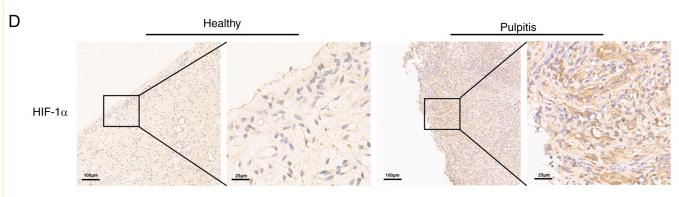 HIF1A Antibody - Figure 1
Expressions of inflammatory cytokines, HIF-1α and FUNDC1 in healthy and pulpitis tissues.