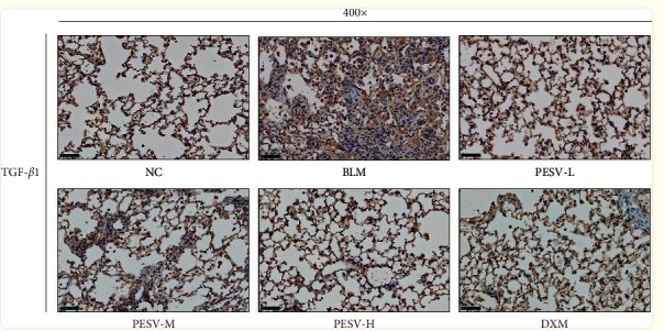 TGF beta 1 Antibody - Figure 5 Immunohistochemical staining of TGF-β1 in the lung tissue of mice in each group (400-fold, scale bar = 50 μm).