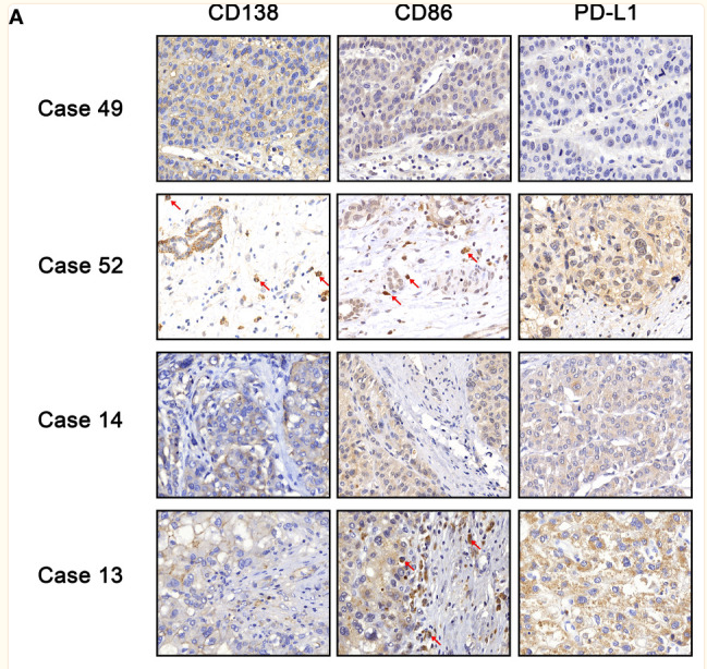 CD86 Antibody - Figure 6 (A) Immunohistochemistry of CD138, CD86, and PD-L1.