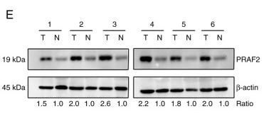beta Actin Antibody - Figure 1 PRAF2 expression in breast cancer and normal adjacent tissues.