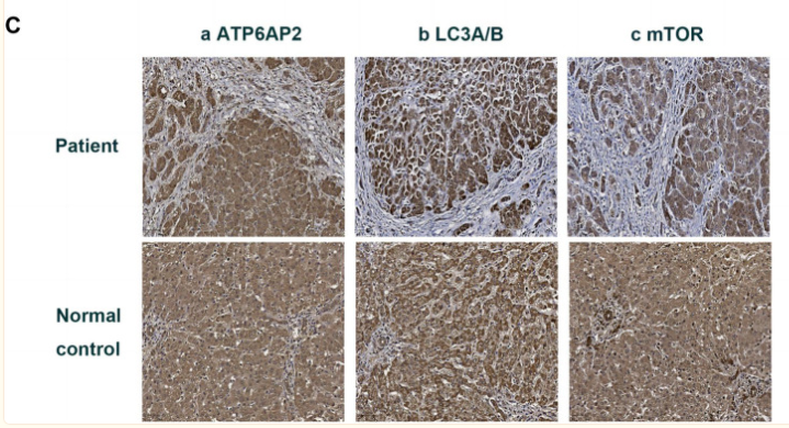 mTOR Antibody - FIGURE 1 Imaging and pathologic findings of the patient.