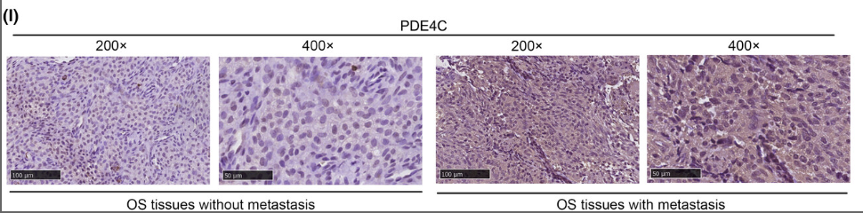 PDE4C Antibody - FIGURE 5 TAM-derived gene PDE4C was associated metastasis in OS patients.