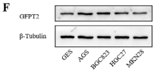 GFPT2 Antibody - Figure 1 GFPT2 expression in GC patients and cell lines.