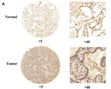 EXO1 Antibody - Figure 3 Expression and prognostic value of EXO1 in our cohort.