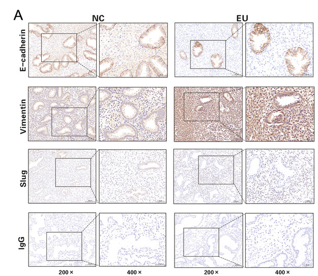SNAI2 Antibody - Figure 2 Impaired MET formation is related to decidualization failure in endometriosis.