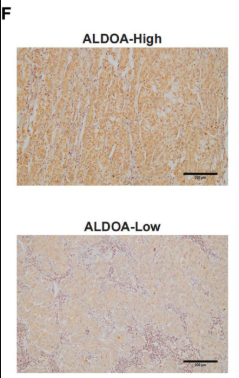 ALDOA Antibody - Figure 6 ALDOA overexpression is associated with an immunosuppressive TME (A) Venn plot showing the shared up-regulated genes with prognostic relevance in the MRS2-epithelial cells and patients with the MRS2 phenotype.