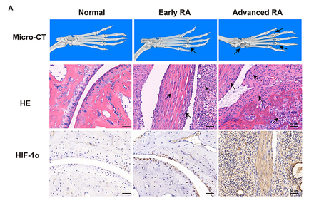 HIF1A Antibody - Figure 3 Different pathological characteristics of early and advanced-stage arthritis mice.