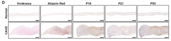 CDKN2A/p16INK4a Antibody - Figure 1 Cellular senescence is associated with aortic valve calcification.