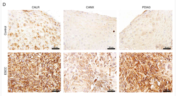 Calnexin Antibody - Figure 1 - CALR is upregulated in ESCC and positively associated with CANX and PDIA3.