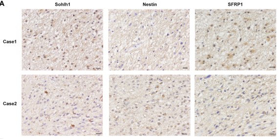 SFRP1 Antibody - FIGURE 8 Sohlh1 is negatively correlated with the expression of Nestin and positively correlated with the expression of SFRP1 in glioma tissues.