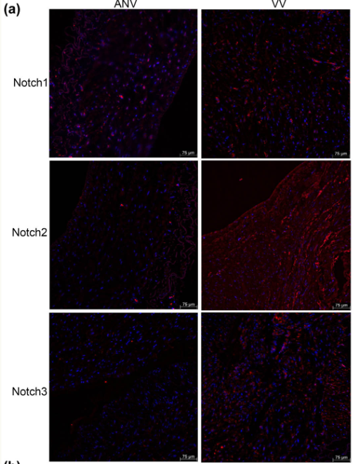 Cleaved-Notch 1 (Val1744) Antibody - Figure 1 The expression of Notch 1, 2, and 3 in varicose vein (VV) tissues and adjacent normal vein (ANV) samples.