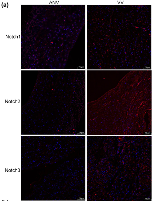 Cleaved-Notch2 (Asp1733) Antibody - Figure 1 The expression of Notch 1, 2, and 3 in varicose vein (VV) tissues and adjacent normal vein (ANV) samples.