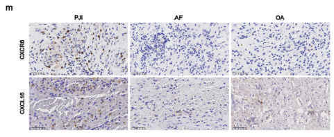 CXCR6 Antibody - Figure 5 PJI patients with high CXCR6 showed a higher recurrence rate.
