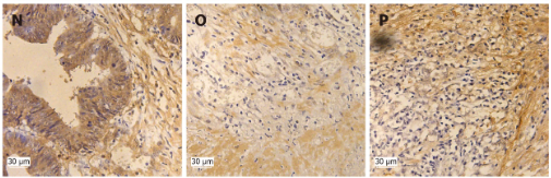 Phospho-Cyclin E1 (Thr395) Antibody - Figure 1 Expression of Cx43, Skp1-Cullin1-F-box (SCF)FBXW7, Phosphorylation of cyclin E1 (p-cyclin E1) (Ser73, Thr77, Thr395) in 38 colon cancer tissue cases.