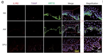 IL1R2 Antibody - Figure 2Subtypes of keratinocytes in NS, AW, and DFU tissues.