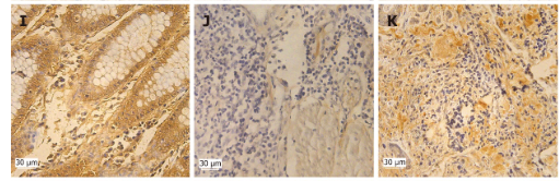Phospho-Cyclin E1 (Ser73) Antibody - Figure 1 Expression of Cx43, Skp1-Cullin1-F-box (SCF)FBXW7, Phosphorylation of cyclin E1 (p-cyclin E1) (Ser73, Thr77, Thr395) in 38 colon cancer tissue cases.