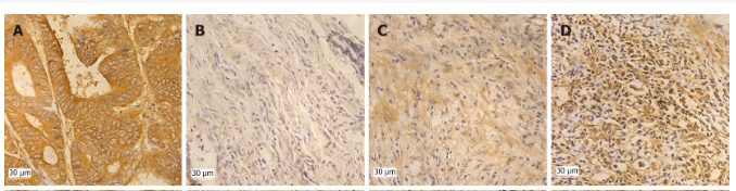 Connexin 43 / GJA1 Antibody - Figure 1 Expression of Cx43, Skp1-Cullin1-F-box (SCF)FBXW7, Phosphorylation of cyclin E1 (p-cyclin E1) (Ser73, Thr77, Thr395) in 38 colon cancer tissue cases.