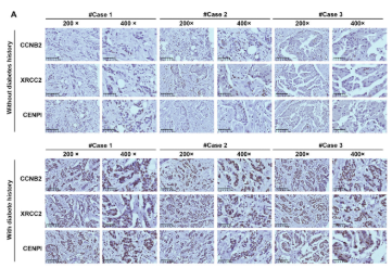 CENPI Antibody - FIGURE 7 CCNB2, XRCC2, and CENPI were up-regulated in BC tissues from patients with a diabetes history.