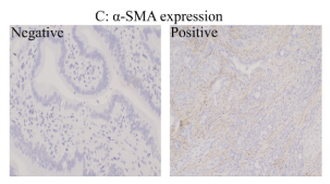 alpha-SMA Antibody - FIGURE 2 mmunohistochemical staining in resected pancreatic cancer specimens.