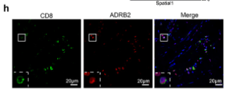 ADRB2 Antibody - Figure 5 metaTF reveals TF activity heterogeneity in human breast cancer T cells.