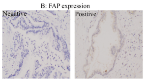 FAP Antibody - FIGURE 2 mmunohistochemical staining in resected pancreatic cancer specimens.