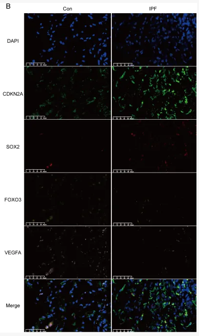 VEGFA Antibody - Figure 14 Experimental validation of key CS-DEGs in clinical samples.