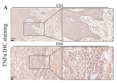 TNF alpha Antibody - Figure 4: Inflammatory factors in chronic diabetic ulcers.
